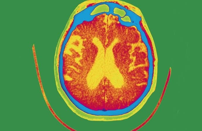 Experimental therapy gantenerumab fails to slow or improve Alzheimers memory loss in clinical trials | CNN